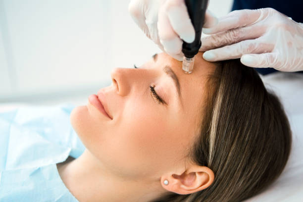 Collagen Induction Therapy